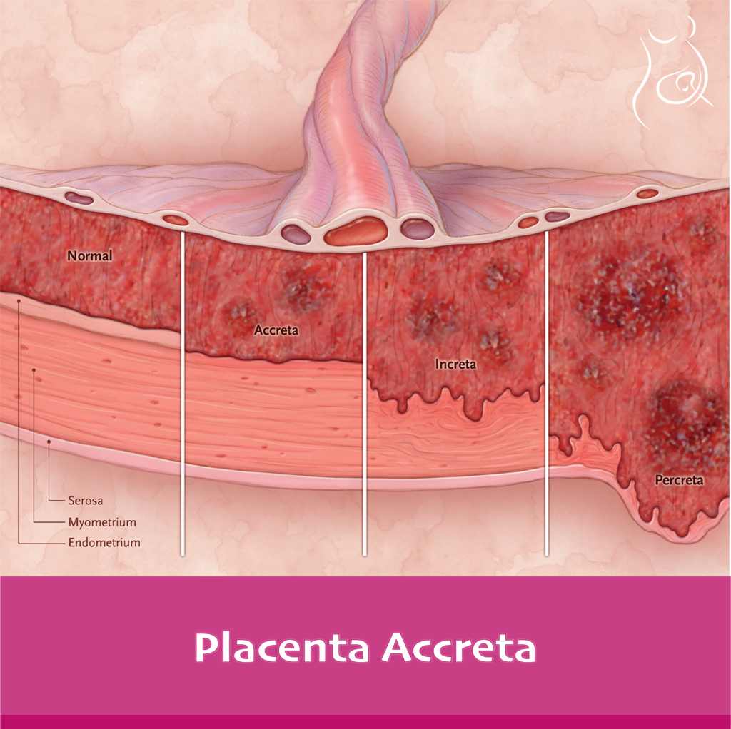 Placenta Accreta Meaning In Urdu